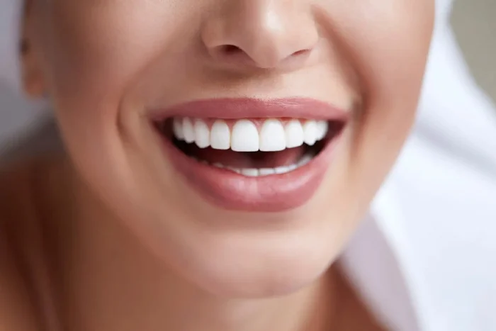 Composite Resin Veneers