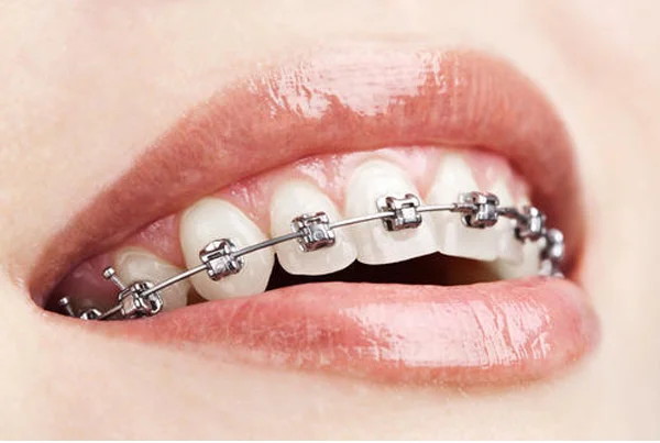 Orthodontics/Braces 