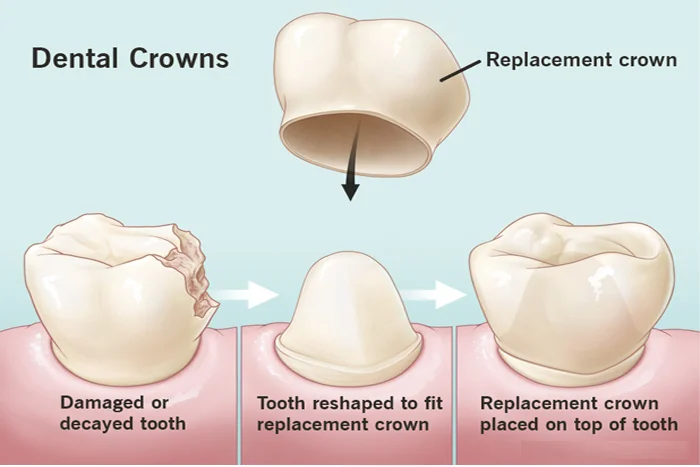 Crowns