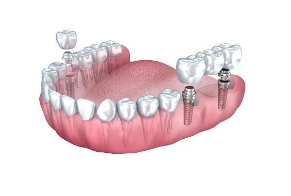 Multiple Tooth Dental Implants