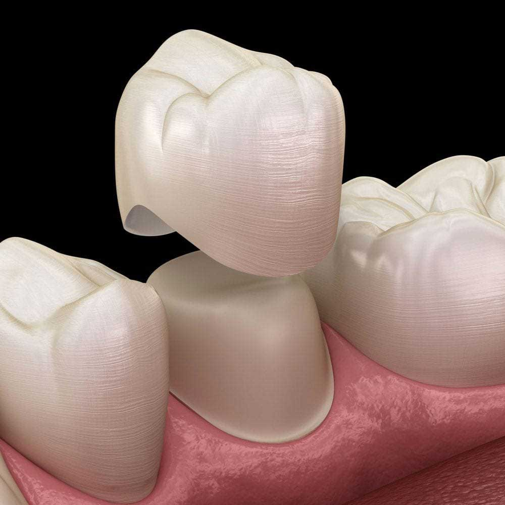 Ceramic crowns