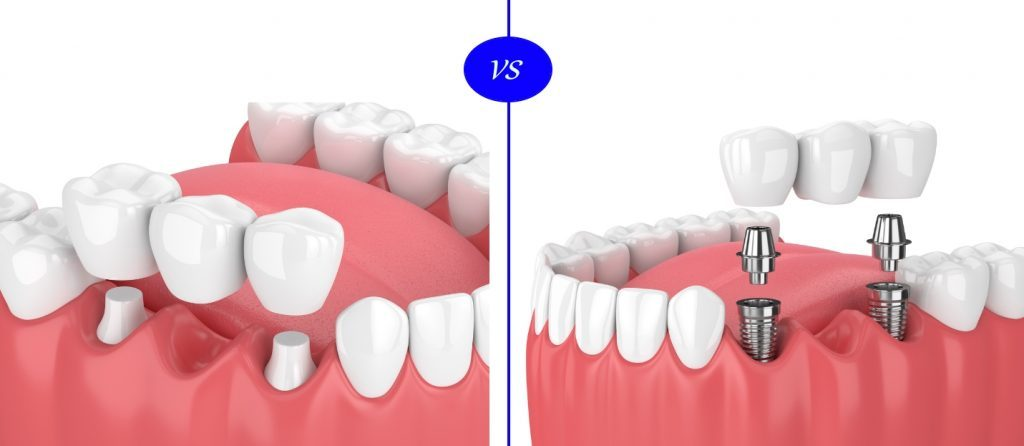 Best Ceramic crowns