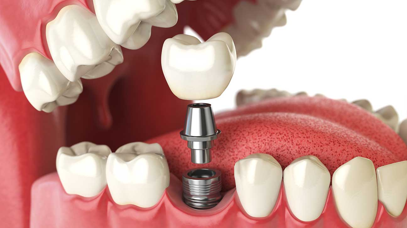 DENTAL IMPLANTS