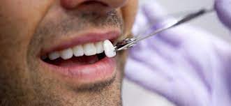 Teeth Scaling treatment