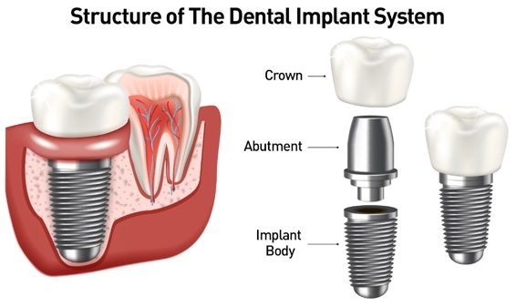 dental implants