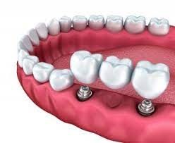 BEST DENTAL IMPLANTS