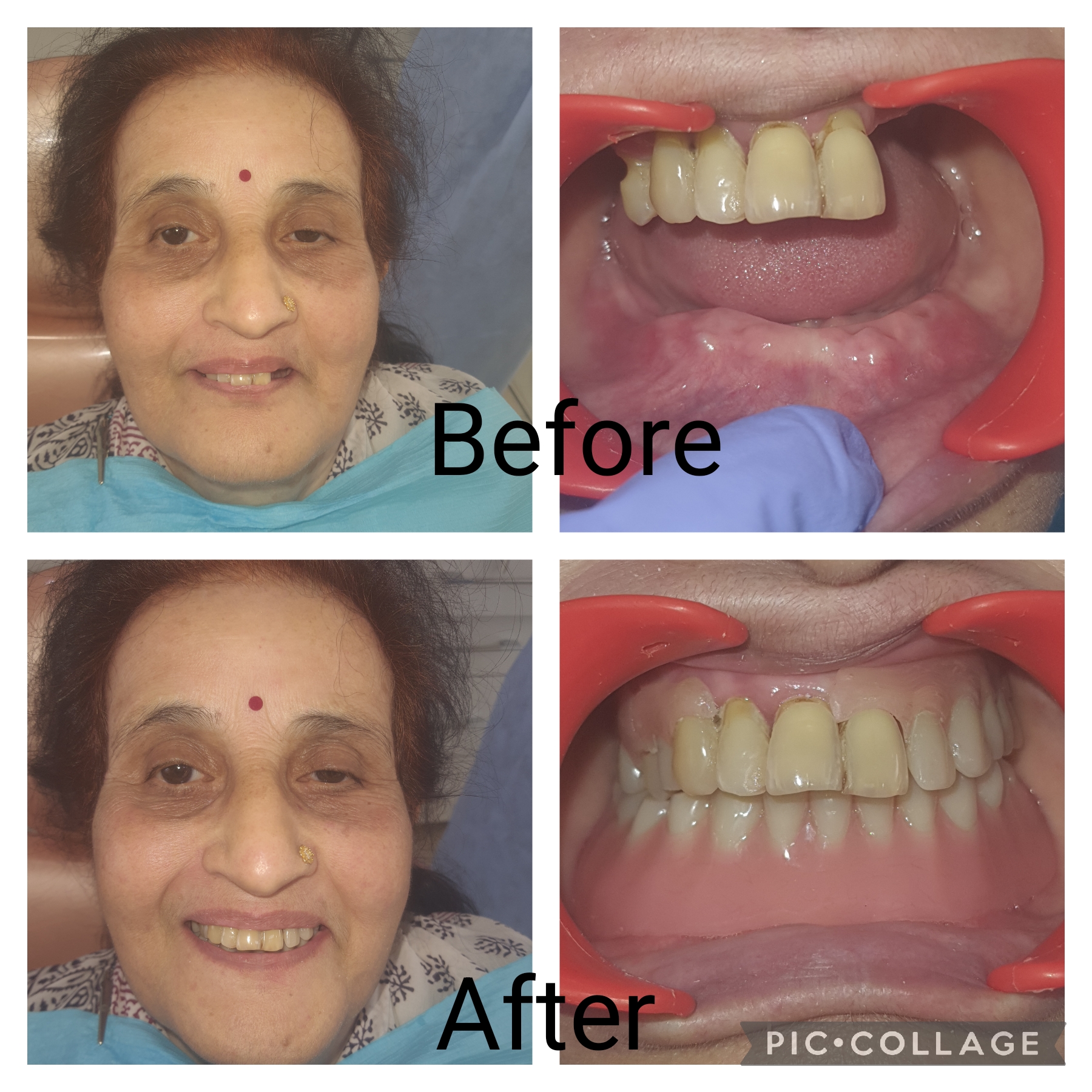 removable dentures in greater noida