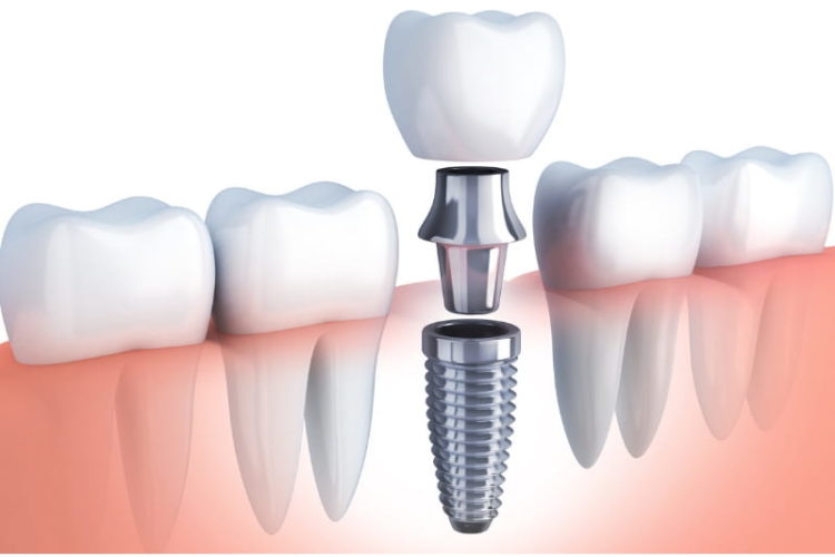 DENTAL IMPLANTATION