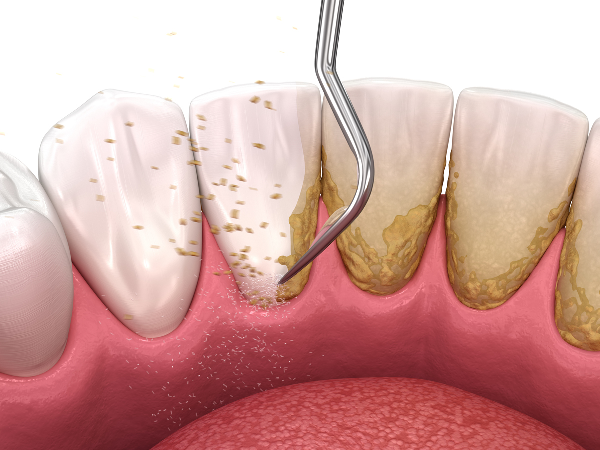 TEETH SCALING TREATMENT