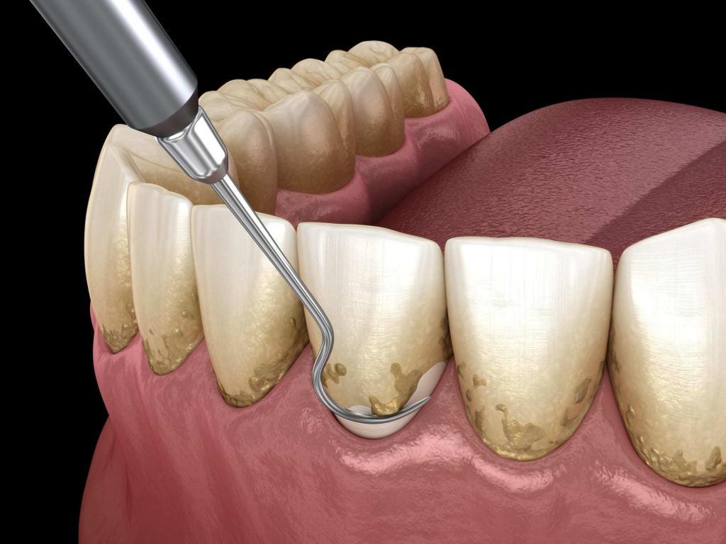 TEETH SCALING