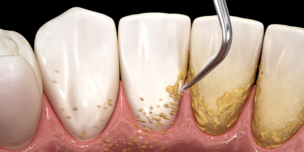 TEETH SCALING TREATMENT