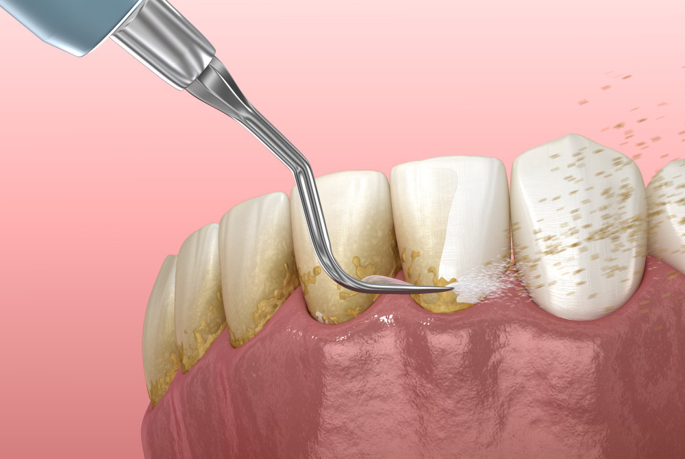 TEETH SCALING