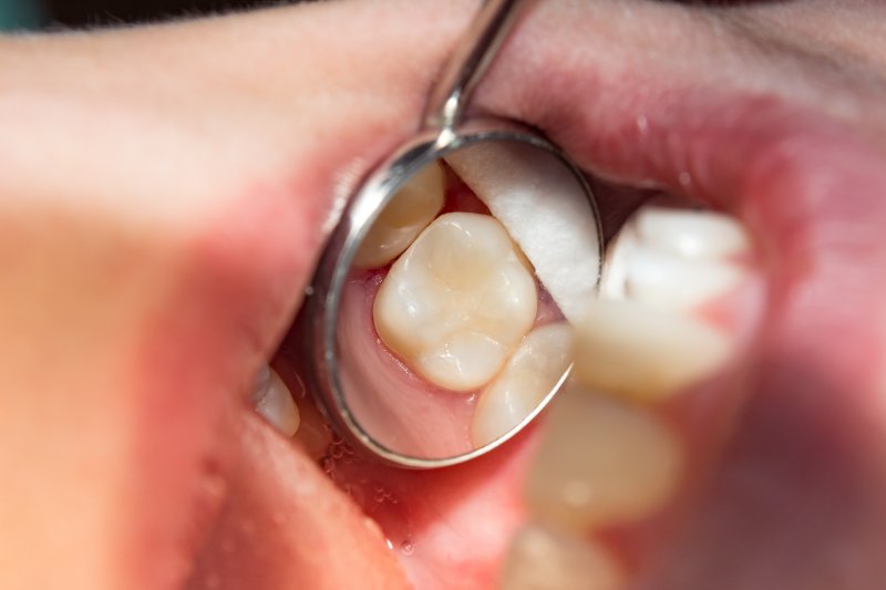 TOOTH COLOURED FILLINGS