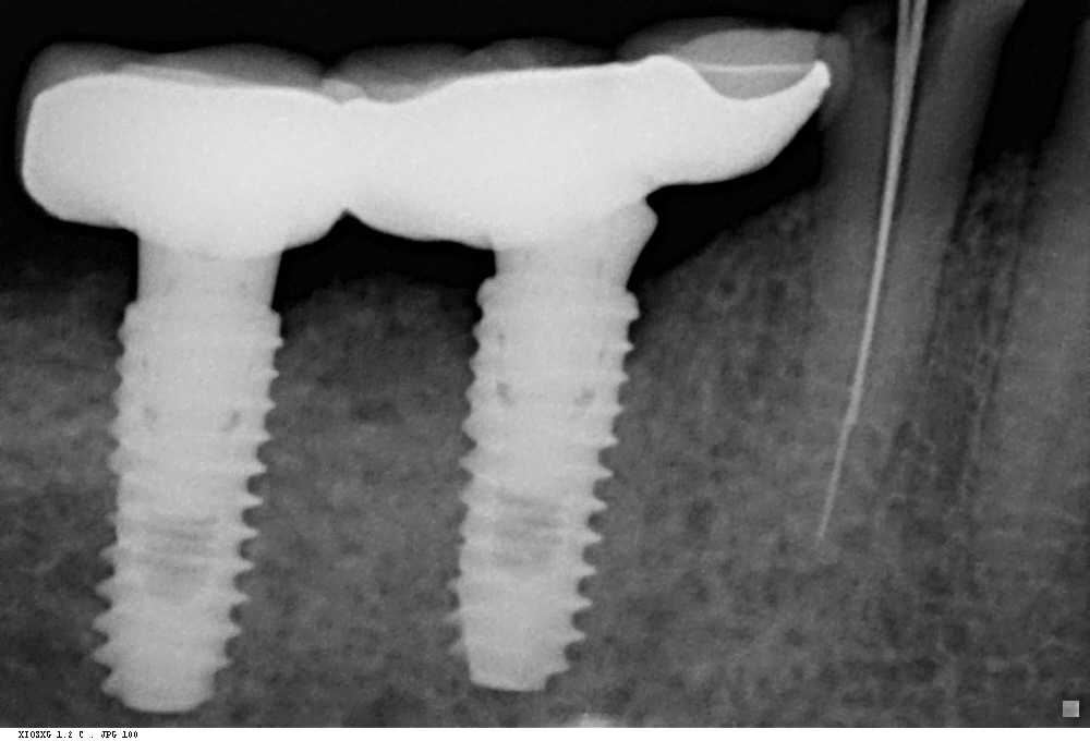 DENTAL IMPLANTS