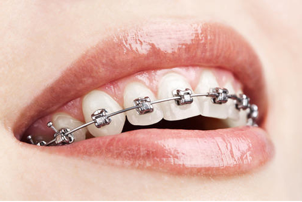 Braces Treatment