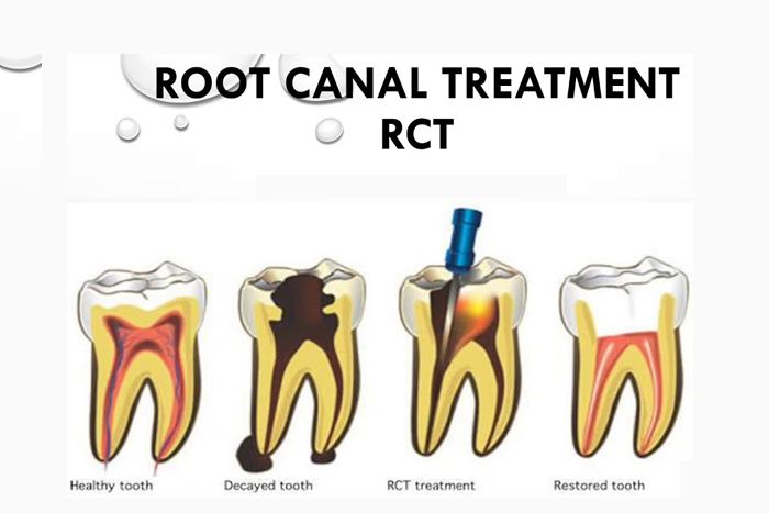 Painless Root Canal Treatment