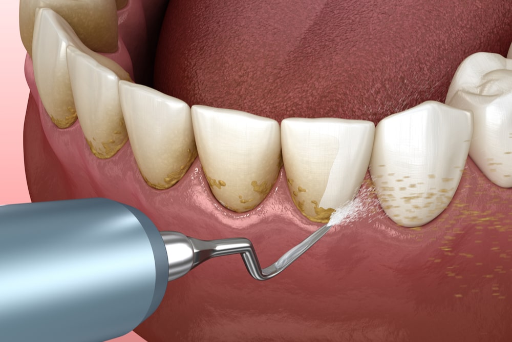 TEETH SCALING CLINIC